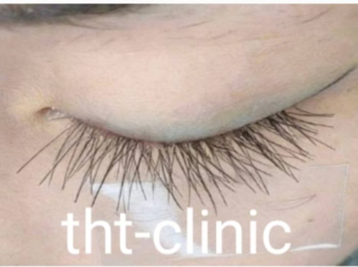 Результат пересадки ресниц по методу THT-Clinic