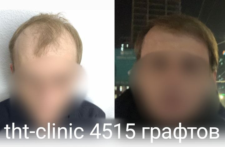 Результат процедуры 4
