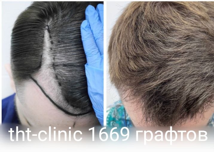 Результат процедуры 13