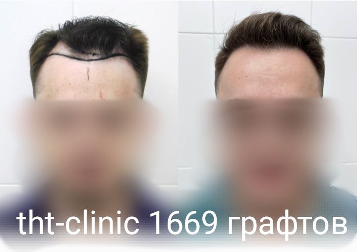 Результат процедуры 15