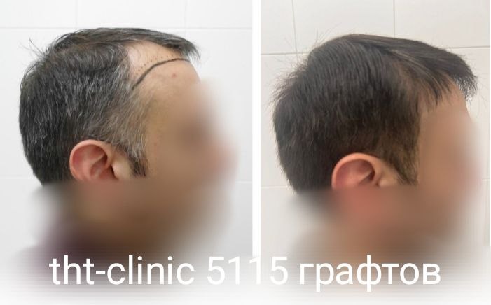 Результат процедуры 23