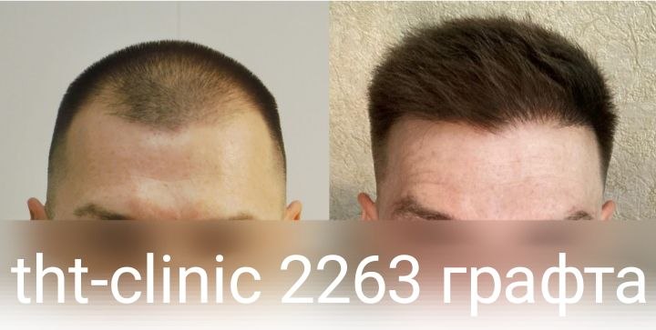 Результат процедуры 25